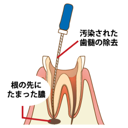 歯根の汚れを除去