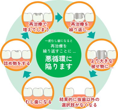 一度むし歯になると再治療を繰り返すことに…悪循環に陥ります
