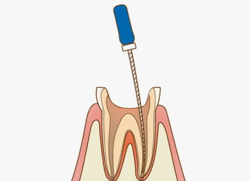 感染した歯の神経の除去