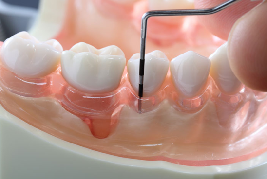 慢性疾患である歯周病の治療